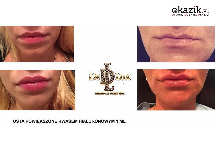 Kupon zniżkowy na powiększanie ust kwasem hialuronowym. Salon DE LUX, Katowice! (100 zł)