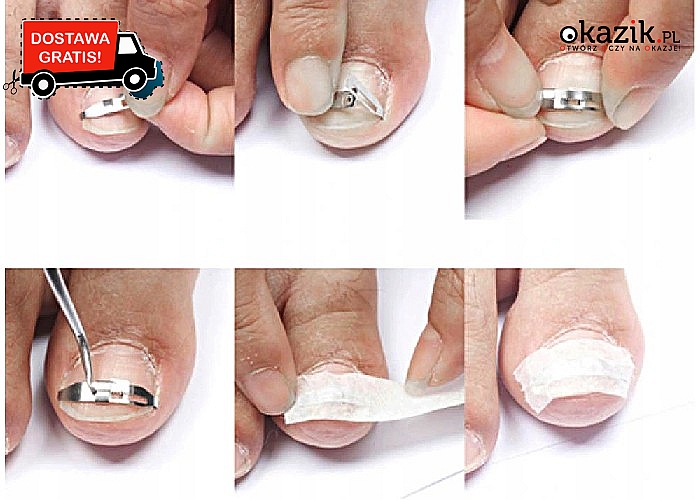 Bezinwazyjny zestaw przeznaczony dla osób z problem wrastających paznokci, który można stosować w domu.